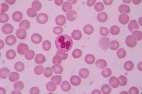 Blood smear shows large number of cancer leukemia cells(Blast cells)