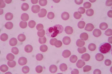 Blood smear shows large number of cancer leukemia cells(Blast cells)
