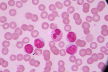 Blood smear shows large number of cancer leukemia cells(Blast cells)