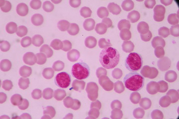 Blood smear shows large number of cancer leukemia cells(Blast cells)