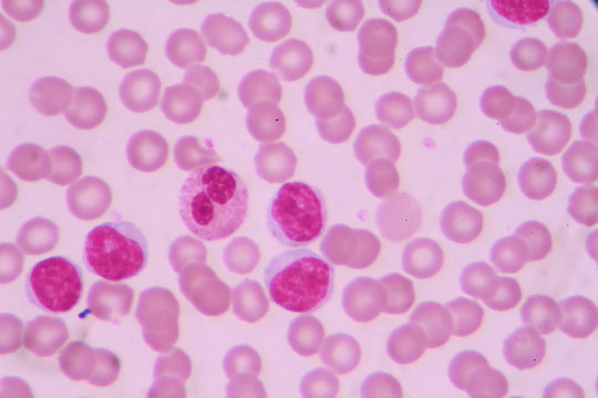 Blood smear shows large number of cancer leukemia cells(Blast cells)