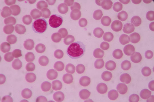 Blood smear shows large number of cancer leukemia cells(Blast cells)