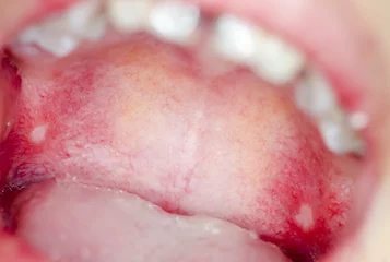 Macro close up and depth of field (DOF) infection  in open mouth - infection of ulcer inside mouth © mrfiza