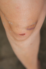 Naklejka premium Scratch on the knee caused by a fall.