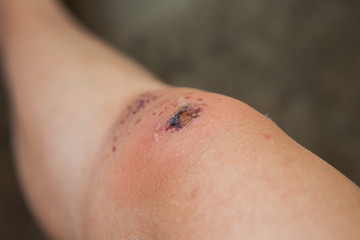Scratch on the knee caused by a fall.