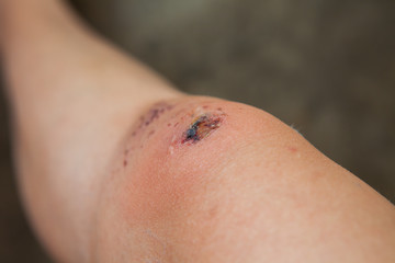 Fototapeta premium Scratch on the knee caused by a fall.