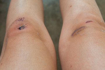 Fototapeta premium Scratch on the knee caused by a fall.