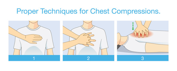 Proper techniques for chest compression. Illustration about emergency help and perform CPR. First aid for person has stopped breathing.  - obrazy, fototapety, plakaty