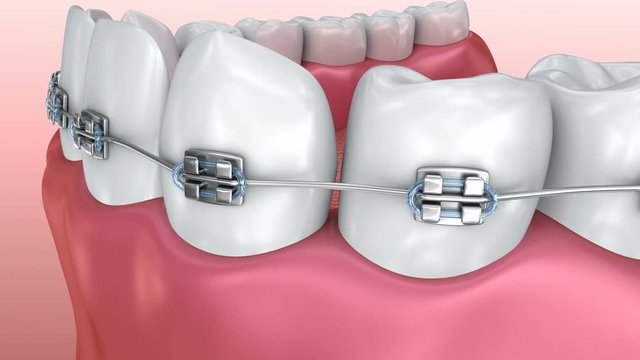 Teeth with braces isolated on white. Medically accurate 3D animation.