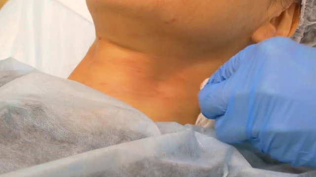 injections of BOTOX in folds around the neck
