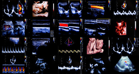 Colourful ultrasound monitor images