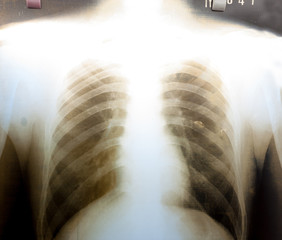 X-Ray Image of human chest