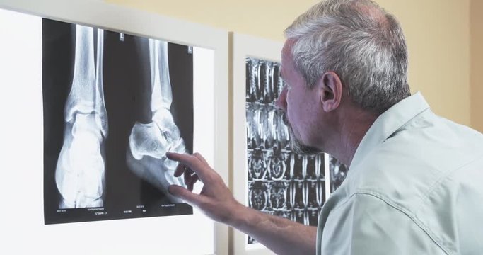Male doctor reviewing x-ray 4k video. Orthopedist puts xray leg foot scan image on illuminator panel and searching diagnosis