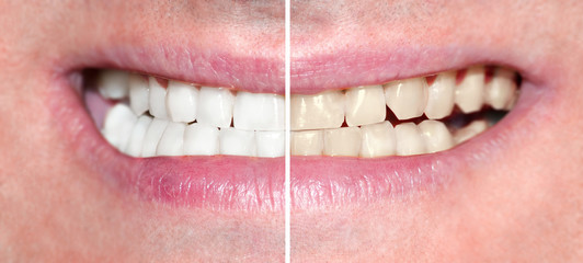 Man smile before and after teeth whitening