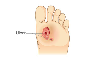 Diabetic Foot Pain and Ulcers. Skin Sores on Foot. Illustration about Diabetes Symptoms.