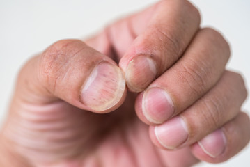 closeup nails having fungus