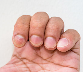 closeup nails having fungus
