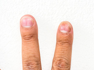 closeup nails having fungus