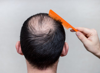 male head with thinning hair or alopecia
 - obrazy, fototapety, plakaty