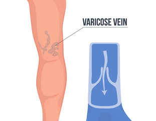 Varicose vein of the leg with blood flow illustration