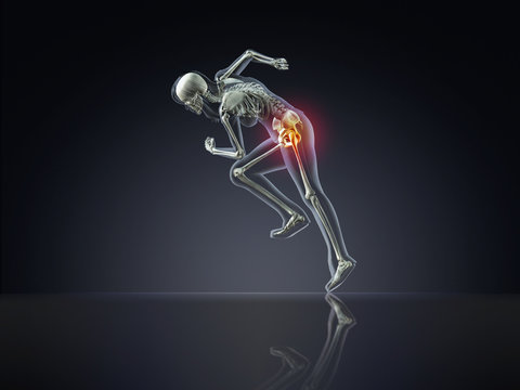 X-Ray Woman Running with Hip Pain
