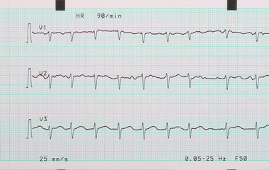 EKG arrhythmia absoluta, printout background