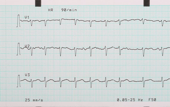 EKG Arrhythmia Absoluta, Printout Background