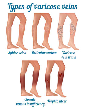 Types of varicose veins.