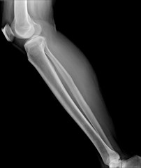 X-ray image of shin , side view
