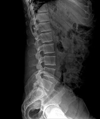 X-ray of the pelvis and spinal column ,side view