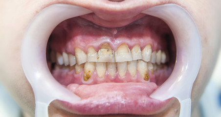 Dental fluorosis - obrazy, fototapety, plakaty