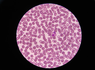 Blood smear shows rouleaux formation and neotrophil