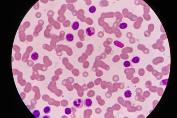 blast cells