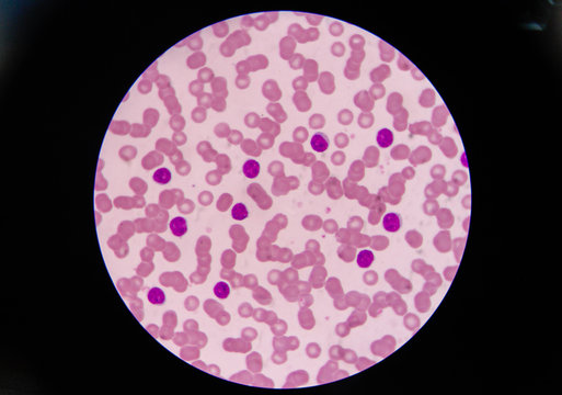 blast cells