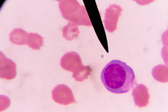 Slide Blood Smear Show Plasme Cell For Complete Blood Count