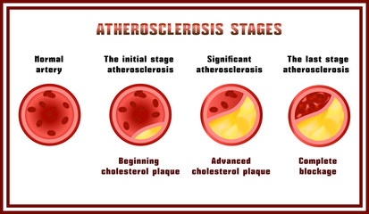 Atherosclerosis stages. Cholesterol plaques.
Disturbance of lipid and protein metabolism, adjournment the cholesterol plaques in arteries.