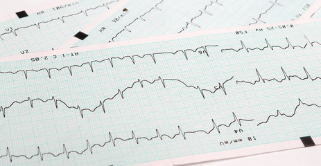 EKG arrhythmia absoluta, printout background - obrazy, fototapety, plakaty