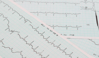 EKG arrhythmia absoluta, printout background