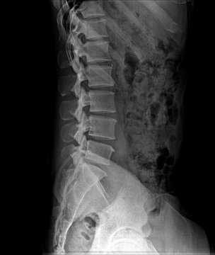 X-Ray Image the spine side view Of Human for a medical diagnosis