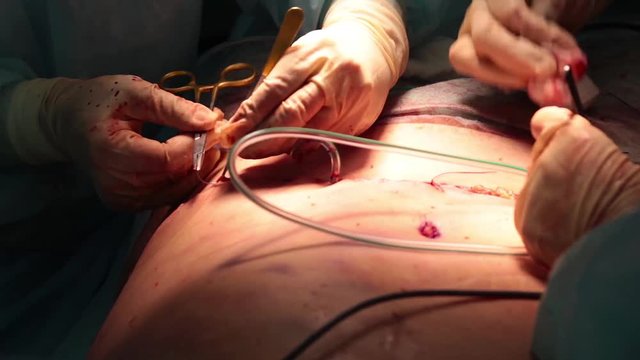 Doctor sews up the patient after surgery for stomach Tummy Tucks