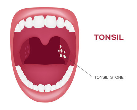 normal tonsil , tonsil stone in the mouth vector