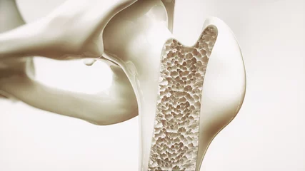 Fotobehang Osteoporosis stage 4 of 4 - upper limb bone - 3d rendering © crevis