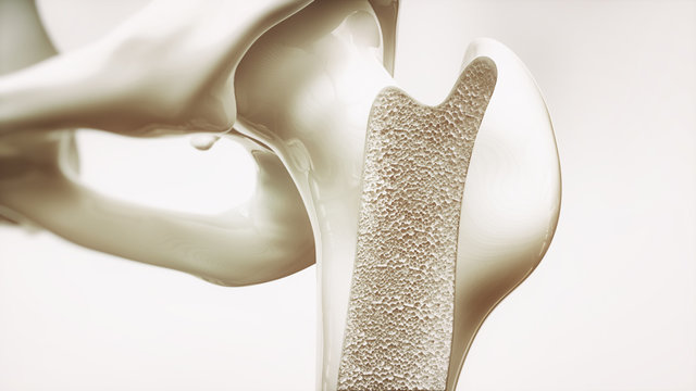 Osteoporosis stage 1 of 4 - upper limb bones - 3d rendering
