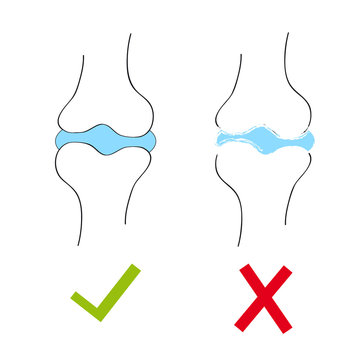 Joint With Cartilage And Arthritis