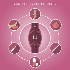 Infographics phlebology, treating varicose veins on women's legs. Varicose vein icons.