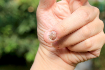 Fungus Infection on Nails Hand, Finger with onychomycosis