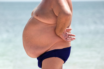 Man with belly. Obese male outdoors. Serious health problem. High risk of hernias.