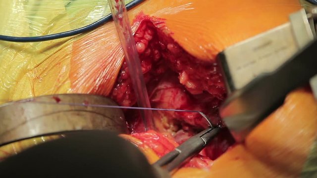 Surgeon pass through a thread under the nerve with a curve needle to protect it during the surgery (1080p; 25fps)