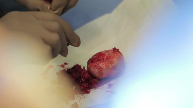 Hip head damaged by coxarthrosis lies on a cloth with a surgeon shakes out a bone chips after removal during the hip replacement surgery (1080p, 25fps)
