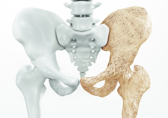 Osteoporosis - upper limb bones - 3d rendering - obrazy, fototapety, plakaty